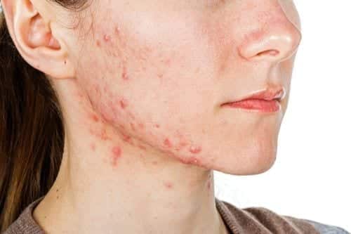 SSA Disability Benefits for Skin Disorders