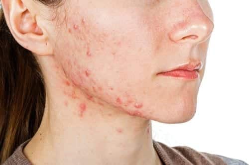 SSA Disability Benefits for Skin Disorders 