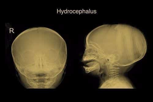 Social Security Disability Benefits for Hydrocephalus