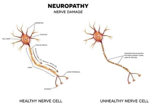 Disability Benefits for Neuropathy 