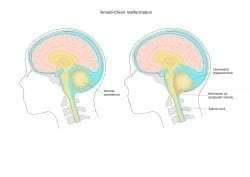 Arnold-Chiari Malformation After Injury