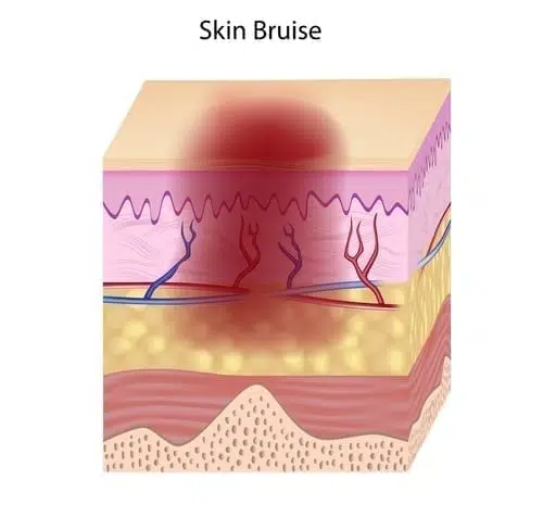 Skin Injury After A Car Accident