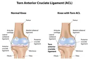 ACL Tears Physcial Therapy NC Workers Compensation