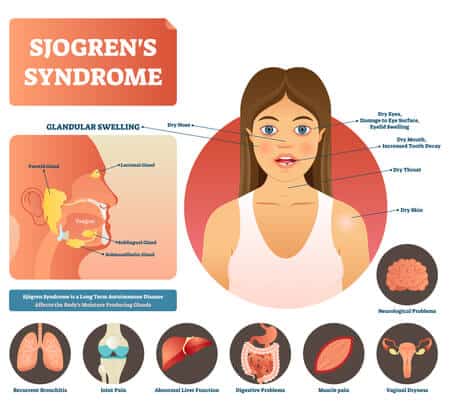 Sjogrens and disability benefits