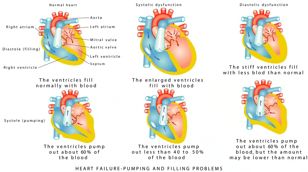 heart failure - pumping and filling problems